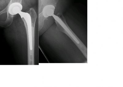 Howmedica Total Hip (Implant 31)